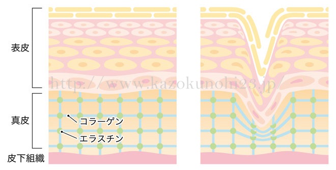 クレータータイプのニキビ跡は、表皮部分より深い真皮層にダメージが及んだためにできたものです。