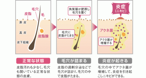 大人ニキビのできるメカニズム