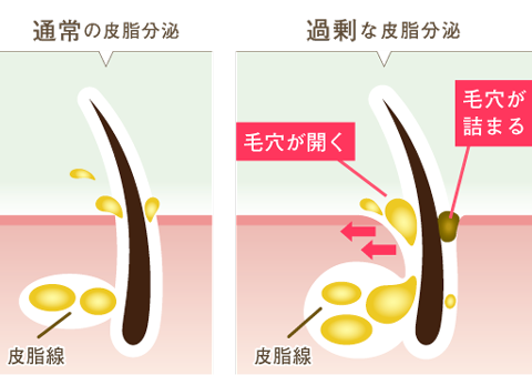 皮脂の過剰分泌