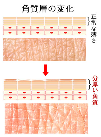 毛穴をつまらせる『角質肥厚』