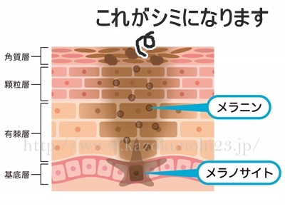 シミの原因はメラニンが表皮に残ってしまうこと。画像は、メラニンが残ってしまってシミが表面化している画像です。