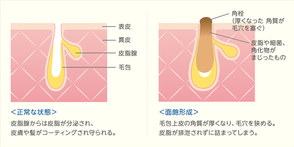 角栓を放置するとトラブルが増える