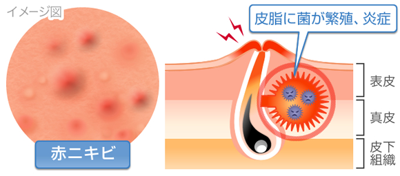 赤ニキビの症状