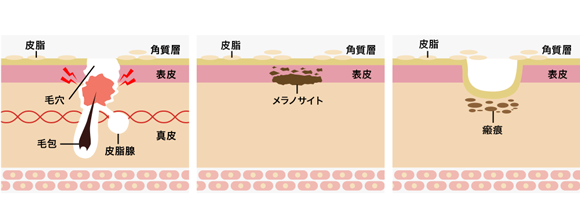 ニキビ跡の種類と原因